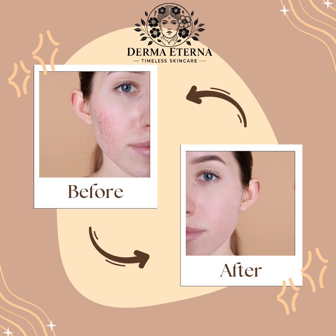 Nettoyant au curcuma – Nettoyant visage anti-acné et éclaircissant | Mousse nettoyante éclaircissante, anti-points noirs et contrôle du sébum