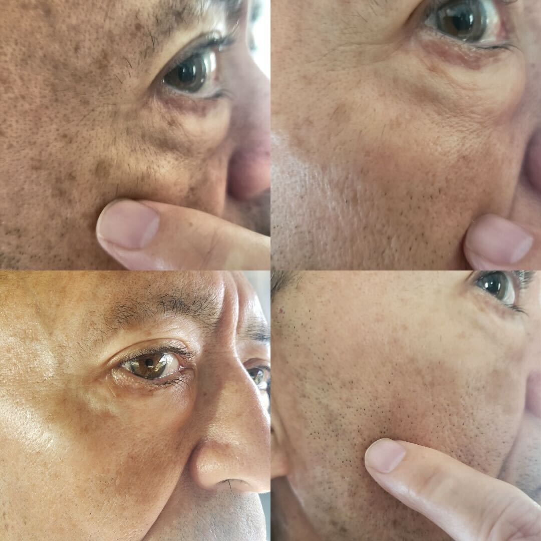 Sérum anti-taches brunes pour peaux normales, à l'acide kojique et aux antioxydants | Fabriqué aux États-Unis | Traitement sûr de l'hyperpigmentation et du mélasma