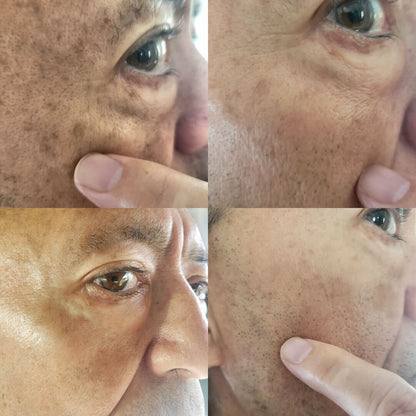 Sérum anti-taches brunes pour peaux normales, à l'acide kojique et aux antioxydants | Fabriqué aux États-Unis | Traitement sûr de l'hyperpigmentation et du mélasma